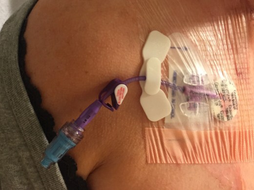 IV Port inserted 2015